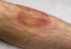 Adverse Effects Linked to Chronic Lyme Disease Treatments Adverse Effects Linked to Chronic Lyme Disease Treatments