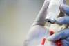 Tumor Necrosis Factor Inhibitors May Increase Extra-articular RA Risk Tumor Necrosis Factor Inhibitors May Increase Extra-articular RA Risk