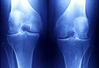 Online Risk Calculator Proves Beneficial in Estimating Risks for Knee OA Online Risk Calculator Proves Beneficial in Estimating Risks for Knee OA