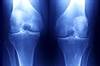 Online Risk Calculator Proves Beneficial in Estimating Risks for Knee OA Online Risk Calculator Proves Beneficial in Estimating Risks for Knee OA