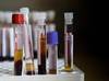High Levels of Serum Uric Acid May Increase Risk for Dementia in the Elderly High Levels of Serum Uric Acid May Increase Risk for Dementia in the Elderly