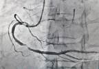 ACS Risk Increased in New-Onset RA Despite Improved Disease Control ACS Risk Increased in New-Onset RA Despite Improved Disease Control