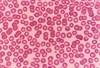 Tocilizumab Associated With Improved Anemia Markers in Patients With Rheumatoid Arthritis Tocilizumab Associated With Improved Anemia Markers in Patients With Rheumatoid Arthritis