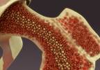 Off-Label Bisphosphonate Use Effective for Edema in Bone Marrow Lesions Off-Label Bisphosphonate Use Effective for Edema in Bone Marrow Lesions