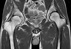 Comparing Tumor Necrosis Factor Inhibitors for RA and SpA: Overview & Expert Interview Comparing Tumor Necrosis Factor Inhibitors for RA and SpA: Overview & Expert Interview