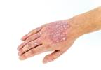 Efficacy and Safety of Ixekizumab Evaluated in Active Psoriatic Arthritis Efficacy and Safety of Ixekizumab Evaluated in Active Psoriatic Arthritis