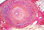 Color Duplex Sonography for the Diagnosis, Management of Giant Cell Arteritis Color Duplex Sonography for the Diagnosis, Management of Giant Cell Arteritis