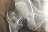 Gout, Urate-Lowering Therapy Not Associated With Risk for Fragility Fracture Gout, Urate-Lowering Therapy Not Associated With Risk for Fragility Fracture