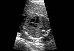 Anti-Ro/SSA-Positive Pregnancies and Fetal Cardiac Conduction Disturbances Anti-Ro/SSA-Positive Pregnancies and Fetal Cardiac Conduction Disturbances