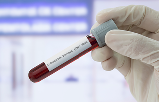 Patients for whom tapering was successful were younger, bDMARD naive, had no concomitant use of corticosteroids, and had low serum CRP levels. Patients for whom tapering was successful were younger, bDMARD naive, had no concomitant use of corticosteroids, and had low serum CRP levels.