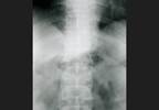 Secukinumab Effectively Inhibits Radiographic Progression of PsA Secukinumab Effectively Inhibits Radiographic Progression of PsA