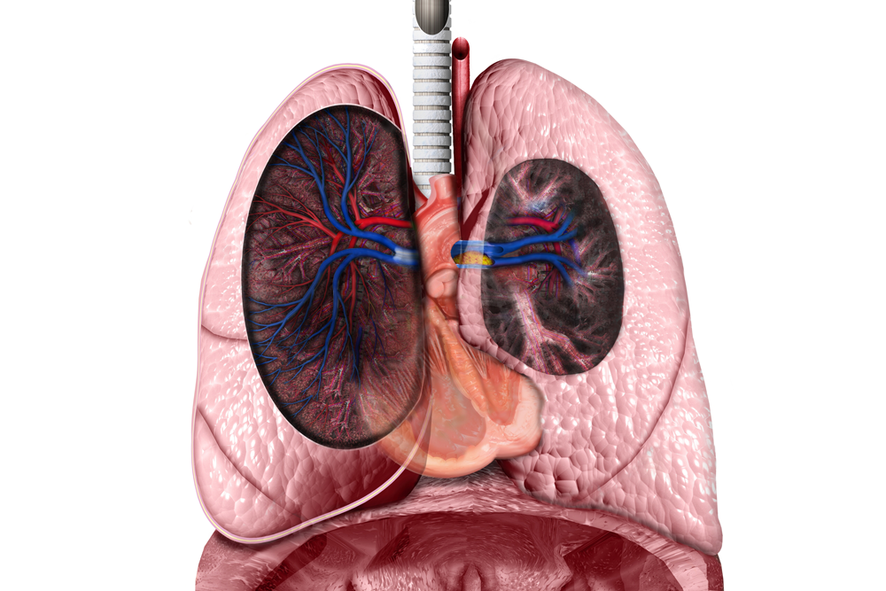 Assessment of Life Expectancy in Scleroderma-Associated Pulmonary