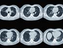 Chronic Cough in Interstitial Lung Disease: More Clinical Trials Needed Chronic Cough in Interstitial Lung Disease: More Clinical Trials Needed
