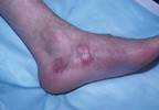 Rebound in Disease Activity in Patients With PsA After TNFi Discontinuation Rebound in Disease Activity in Patients With PsA After TNFi Discontinuation