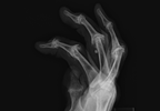 Early Response in Psoriatic Arthritis Treatment Predicts Long-Term Outcomes Early Response in Psoriatic Arthritis Treatment Predicts Long-Term Outcomes