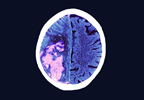 Gout Increases Incident Stroke Risk by the Same Magnitude as Diabetes Gout Increases Incident Stroke Risk by the Same Magnitude as Diabetes