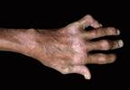 Apremilast Monotherapy Effective for DMARD-Naive Psoriatic Arthritis Apremilast Monotherapy Effective for DMARD-Naive Psoriatic Arthritis