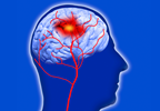 Ankylosing Spondylitis Associated With Higher Risk for Cardiovascular Events Ankylosing Spondylitis Associated With Higher Risk for Cardiovascular Events