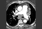 Predicting Mortality in Systemic Sclerosis-PAH With CT Signs of Veno-Occlusive Disease Predicting Mortality in Systemic Sclerosis-PAH With CT Signs of Veno-Occlusive Disease