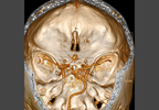 Azathioprine With Glucocorticoids in Nonsevere Systemic Necrotizing Vasculitides Azathioprine With Glucocorticoids in Nonsevere Systemic Necrotizing Vasculitides