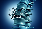 Fracture Risk in Postmenopausal Women With Osteoporosis May Improve With Growth Hormone Therapy Fracture Risk in Postmenopausal Women With Osteoporosis May Improve With Growth Hormone Therapy