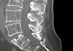 Do Biologic DMARDs Affect Spinal Fracture Risk in Ankylosing Spondylitis? Do Biologic DMARDs Affect Spinal Fracture Risk in Ankylosing Spondylitis?
