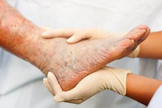 Allopurinol use of 181 days to 2 years was associated with a lower risk of peripheral arterial disease compared with no allopurinol use. Allopurinol use of 181 days to 2 years was associated with a lower risk of peripheral arterial disease compared with no allopurinol use.