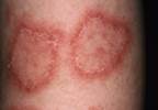 Atacicept Effective for Systemic Lupus Erythematosus Activity, Severity Atacicept Effective for Systemic Lupus Erythematosus Activity, Severity