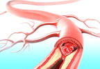 CV Risk Scores Underestimate Subclinical Atherosclerosis in Psoriatic Arthritis CV Risk Scores Underestimate Subclinical Atherosclerosis in Psoriatic Arthritis