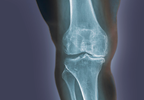 Knee Pain in Osteoarthritis Associated With Long-Term Prefrailty, Frailty Knee Pain in Osteoarthritis Associated With Long-Term Prefrailty, Frailty