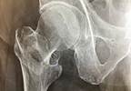 Regional Nerve Block May Reduce Pain, Time to Mobilization After Hip Fracture Regional Nerve Block May Reduce Pain, Time to Mobilization After Hip Fracture