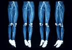ACC, AHA Publish Appropriate Use Criteria Guidelines for Peripheral Artery Intervention ACC, AHA Publish Appropriate Use Criteria Guidelines for Peripheral Artery Intervention