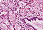 Pneumonia Incidence in Rheumatic Disease Lowered With Primary Prophylaxis Pneumonia Incidence in Rheumatic Disease Lowered With Primary Prophylaxis