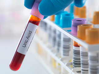 Optimal control of hyperuricemia and metabolic diseases may play a role in improving psoriatic arthritis outcomes. Optimal control of hyperuricemia and metabolic diseases may play a role in improving psoriatic arthritis outcomes.