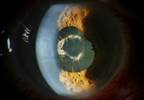Determining Risk for New-Onset Uveitis in Juvenile Idiopathic Arthritis Determining Risk for New-Onset Uveitis in Juvenile Idiopathic Arthritis