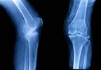 Examining the Effectiveness of Bisphosphonates for Knee Osteoarthritis Examining the Effectiveness of Bisphosphonates for Knee Osteoarthritis