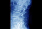 Use of Secukinumab in Ankylosing Spondylitis: Efficacy and Safety Use of Secukinumab in Ankylosing Spondylitis: Efficacy and Safety