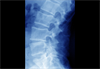 Positive Phase 3 Data Announced for Ixekizumab in Ankylosing Spondylitis Positive Phase 3 Data Announced for Ixekizumab in Ankylosing Spondylitis