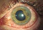 Adalimumab Effective in JIA-Associated Uveitis Unresponsive to Methotrexate Adalimumab Effective in JIA-Associated Uveitis Unresponsive to Methotrexate