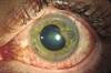 Adalimumab Effective in JIA-Associated Uveitis Unresponsive to Methotrexate Adalimumab Effective in JIA-Associated Uveitis Unresponsive to Methotrexate