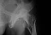 Abatacept May Increase Femoral Neck Bone Mineral Density in Rheumatoid Arthritis Abatacept May Increase Femoral Neck Bone Mineral Density in Rheumatoid Arthritis