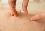 Does Acupuncture Decrease Pain After Joint Replacement Surgery? Does Acupuncture Decrease Pain After Joint Replacement Surgery?