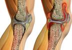 Clinical Assessment of Juvenile Idiopathic Arthritis: Predicting Unfavorable Long-Term Outcomes Clinical Assessment of Juvenile Idiopathic Arthritis: Predicting Unfavorable Long-Term Outcomes