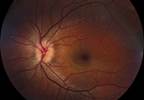 Improved Diagnostic Option for Confirmation of Sarcoidosis in Acute Uveitis Improved Diagnostic Option for Confirmation of Sarcoidosis in Acute Uveitis