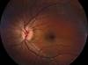 Vitamin D Deficiency Linked to Uveitis, Disease Activity in Juvenile Idiopathic Arthritis Vitamin D Deficiency Linked to Uveitis, Disease Activity in Juvenile Idiopathic Arthritis