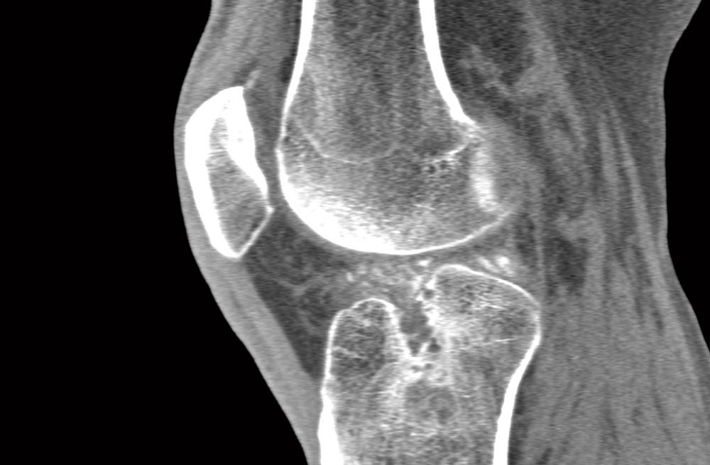 Can i take allopurinol during a gout attack x ray
