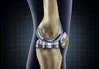 Factors Predicting Pain Outcomes After TKR for Knee Osteoarthritis Factors Predicting Pain Outcomes After TKR for Knee Osteoarthritis