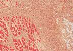 More Severe Disease Found in Juvenile Myositis With Anti-NT5C1A Autoantibodies More Severe Disease Found in Juvenile Myositis With Anti-NT5C1A Autoantibodies