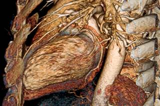 SLE significantly increases the risk for cardiovascular disease. SLE significantly increases the risk for cardiovascular disease.