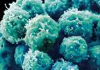 Stem Cell Transplant May Benefit Patients With Systemic Sclerosis Stem Cell Transplant May Benefit Patients With Systemic Sclerosis